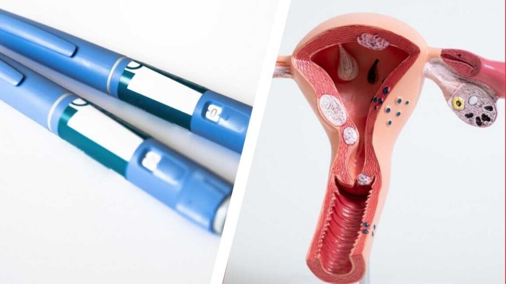 The Connection Between Ozempic and Fibroids